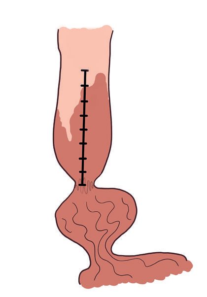 Prague C&M criteria for reporting endoscopic Barrett's oesophagus, recording the circumferential and maximal extent from the oesophagogastric junction