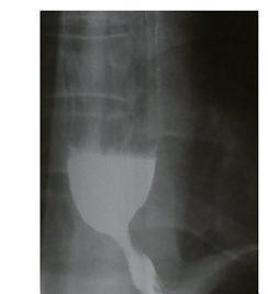 Pseudo-achalasia in a patient with cancer of the oesophagogastric junction: referred as possible achalasia on the barium contrast study, but endoscopy could not pass the obstruction, prompting CT
