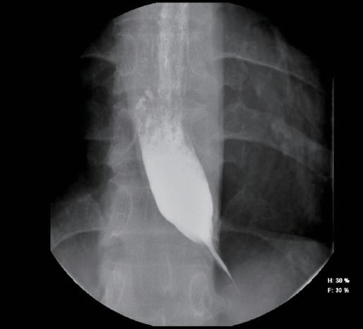 Barium contrast study showing the typical 