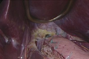 Laparoscopic myotomy and Dor hemi-fundoplication: the lower oesophageal myotomy extending onto the stomach for at least 2 cm, then completion of the myotomy with the endoscope light shining through the thin mucosa