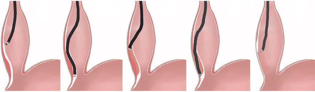 The procedure of peroral endoscopic myotomy (POEM): mucosal opening, submucosal tunnel down to the stomach, myotomy carried into the proximal stomach, closure with endoclips
