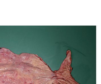 End-stage achalasia: a grossly dilated sigmoid-shaped oesophagus, and the transected oesophagus at resection