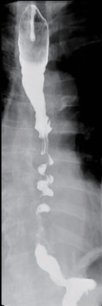 Barium contrast study showing a corkscrew oesophagus in a patient with diffuse oesophageal spasm