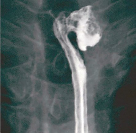 Barium contrast study showing a Zenker's diverticulum