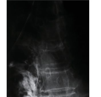 Stent for oesophageal perforation: leakage of oral contrast outside the oesophagus before stenting, and contrast flowing through the stent with no leakage afterwards