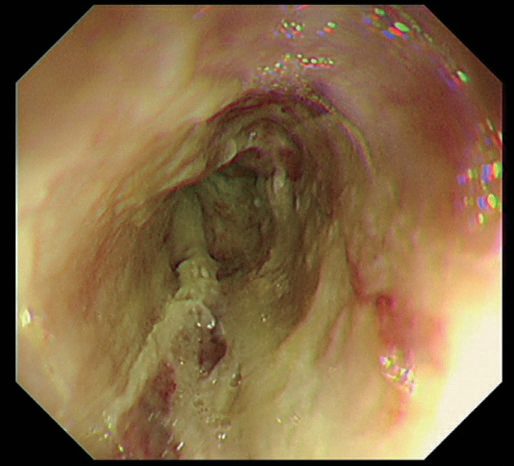 Endoscopy picture showing caustic burn to the oesophagus