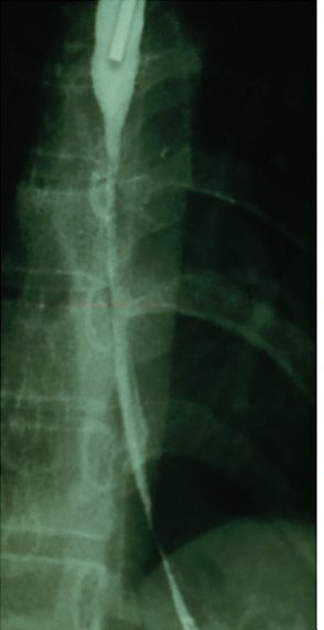 Contrast study showing a long undilatable stricture of the oesophagus secondary to caustic burn, treated by oesophagogastrectomy and colonic interposition