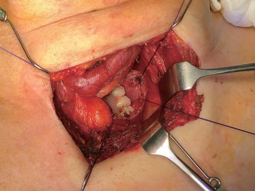 Open surgery was required to extract a broken denture stuck in the cervical oesophagus; the oesophagus was then repaired in two layers