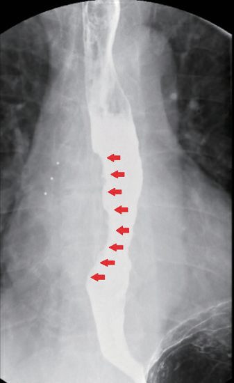 Bronchoscopic picture of airway infiltration by oesophageal cancer, which contraindicates oesophagectomy