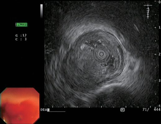 Endoscopic ultrasonography picture of an oesophageal tumour with the layers of the oesophageal wall demonstrated