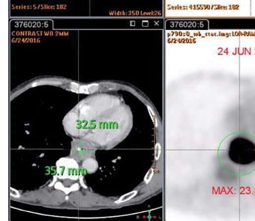 Positron emission tomography/computed tomography for staging of oesophageal cancer