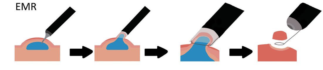 Technique of endoscopic mucosal resection: cap with submucosal injection, and the resected specimen