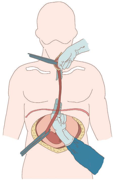 Transhiatal oesophagectomy, whereby the oesophagus is mobilised blindly using fingers from the neck and hand inserted from the abdomen