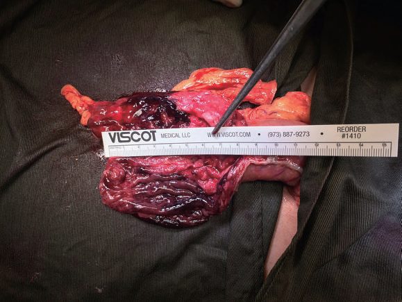 Cervical wound with erythema, swelling and purulent discharge, typical of an anastomotic leak