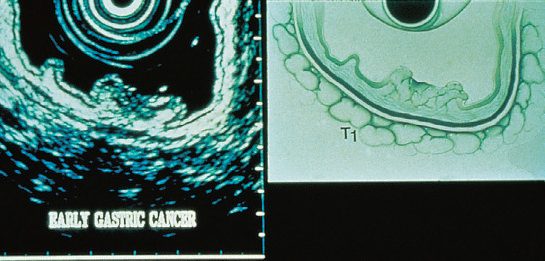 Endoscopic ultrasonography of the stomach: five layers are identifiable in the normal stomach, with a gastric cancer shown invading the muscle of the gastric wall