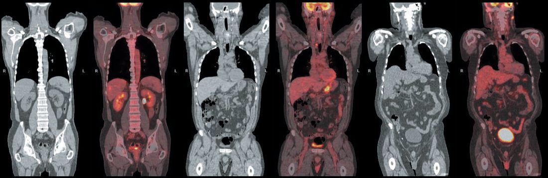 CT/PET in gastric cancer: the middle pair shows the primary tumour, the left pair unsuspected liver metastases, the right pair a positive left cervical node
