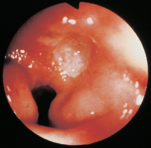 Duodenal ulcer at gastroduodenoscopy