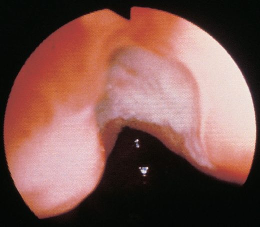 Benign incisural gastric ulcer shown at gastroscopy. All gastric ulcers must be biopsied from the ulcer perimeter regardless of appearance, since about 10% prove malignant