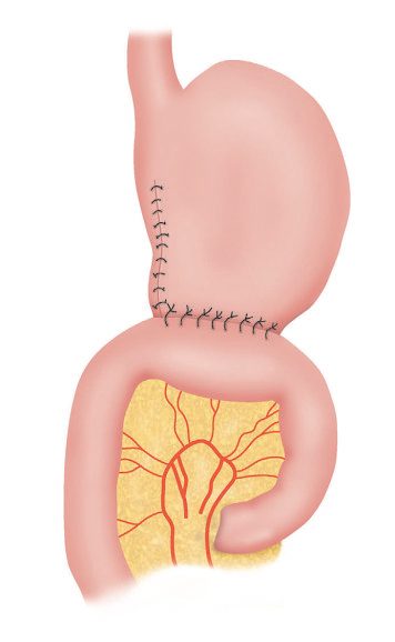 Billroth II reconstruction: two-thirds of the stomach is removed, the duodenal stump is closed and the stomach anastomosed to the jejunum