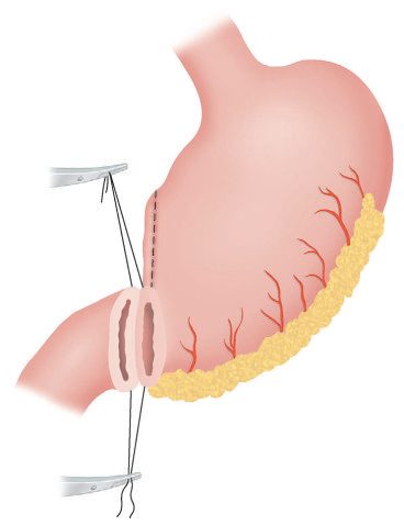 Billroth I gastrectomy: the lower half of the stomach is removed and the cut stomach anastomosed to the first part of the duodenum