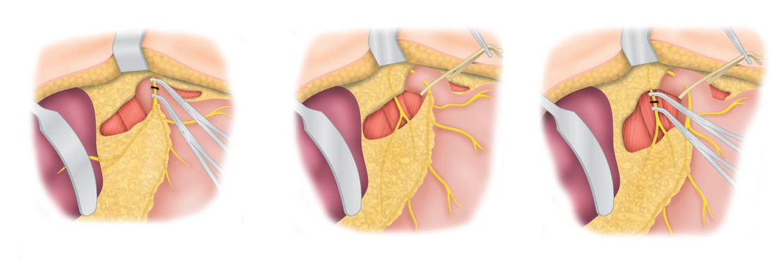 Truncal vagotomy: (a) division of the anterior vagus; (b) mobilisation of the oesophagus; (c) division of the posterior vagus
