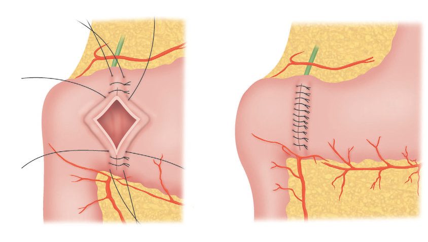 Heineke–Mikulicz pyloroplasty: (a) a full-thickness longitudinal incision traversing the pylorus is retracted by stay sutures (i) and closed transversely with full-thickness sutures (ii); (b) completed transverse closure