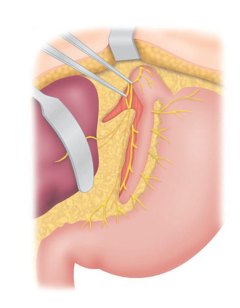 Highly selective vagotomy: the anterior and posterior vagus nerves are preserved but all branches to the fundus and body of the stomach are divided