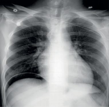 Erect chest radiograph showing air under the right diaphragm in a patient with a perforation