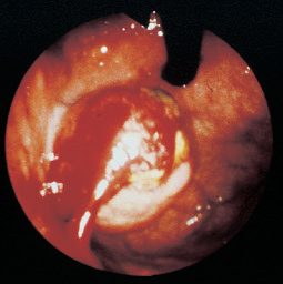 Borrmann classification of advanced gastric cancer: type 1 polypoid, type 2 ulcerating, type 3 infiltrating/ulcerating, type 4 infiltrating (linitis plastica)