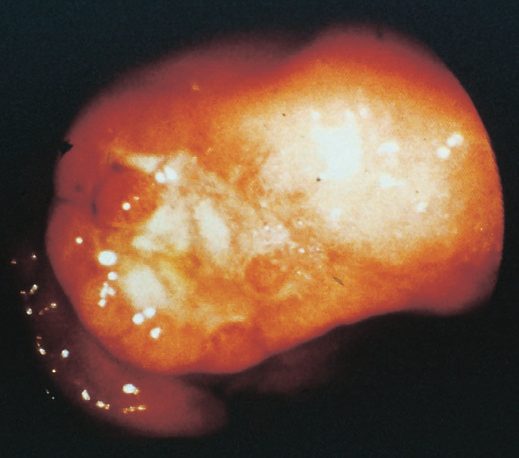 Early gastric cancer at endoscopy: (a) type I protruding; (b) type IIa superficial elevated; (c) type III ulcerated
