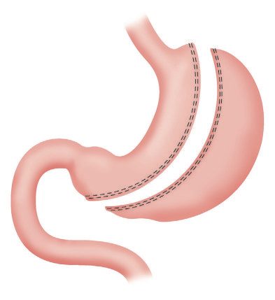 Sleeve gastrectomy