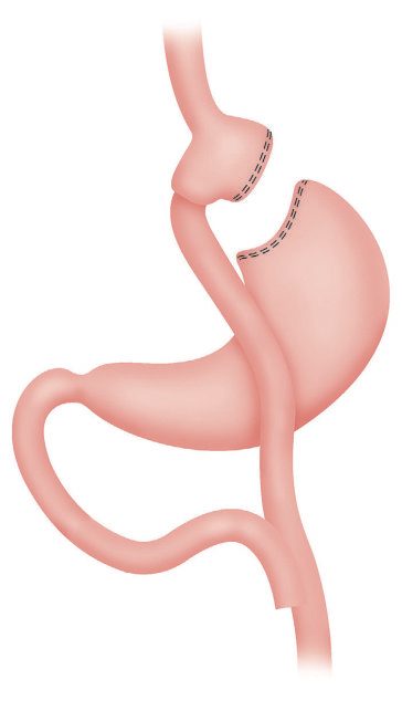 Gastric bypass showing a short vertical lesser curve-based gastric pouch with a Roux-en-Y jejunojejunostomy reconstruction