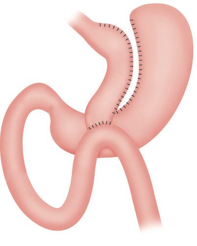 Gastric bypass showing a longer vertical lesser curve-based gastric pouch with gastrojejunostomy reconstruction (one-anastomosis gastric bypass)