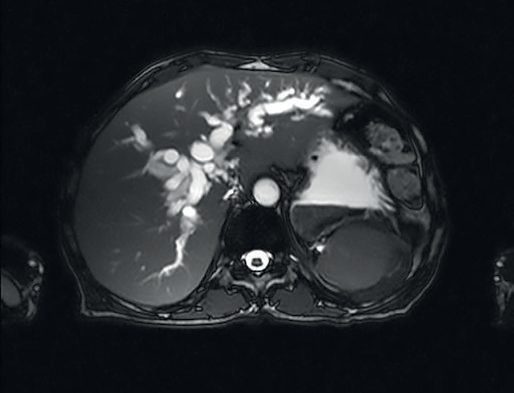 Magnetic resonance imaging showing a hilar cholangiocarcinoma with dilatation of the intrahepatic biliary tree