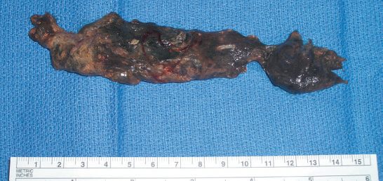 Necrotic body and tail of the pancreas removed as an intact specimen after necrosectomy through a left flank retroperitoneal approach