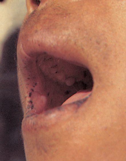 Melanin spots on the lips in Peutz-Jeghers syndrome