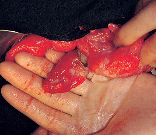 Gangrenous Meckel's diverticulitis