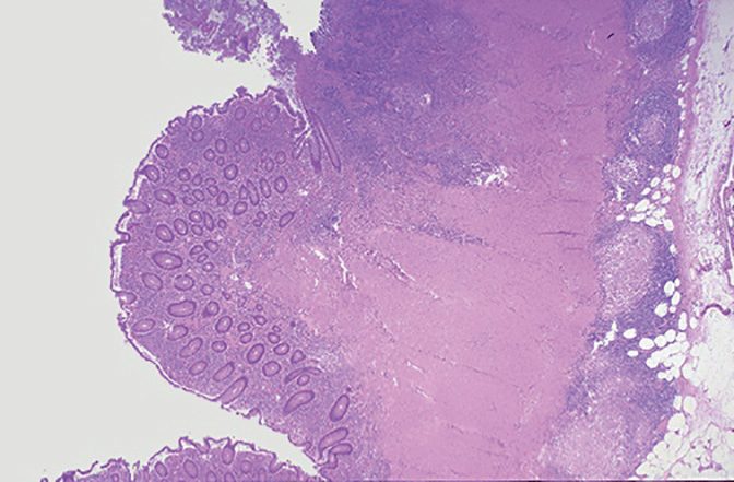 Photomicrograph of Crohn's disease showing mucosal ulceration with transmural inflammation extending through the full thickness of the bowel wall