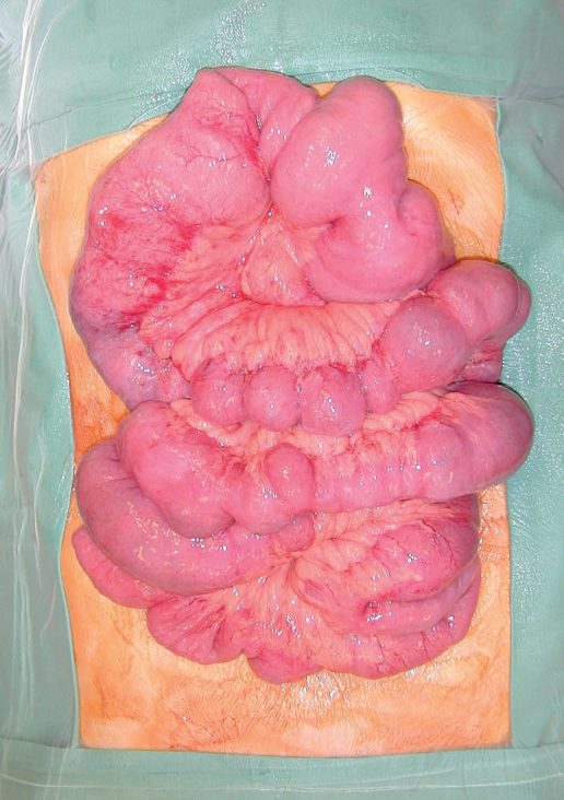 Crohn's disease affecting the jejunum and ileum (jejunoileitis) with multiple strictures and bowel dilatation between skip lesions, treated by multiple strictureplasties