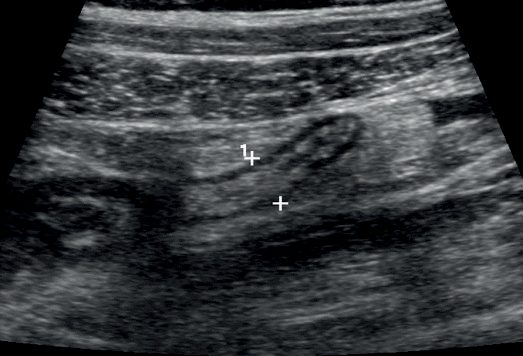 Ultrasound image of the right iliac fossa demonstrating a mildly enlarged appendix, measuring 8 mm in diameter, consistent with acute appendicitis