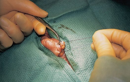 Open appendicectomy: the appendix delivered through a gridiron incision, ligated at its base prior to division