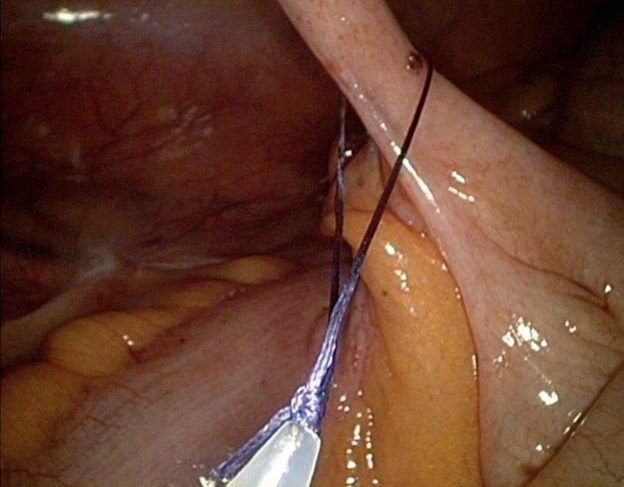 Laparoscopic appendicectomy: the appendix base is ligated with an absorbable endoloop tie