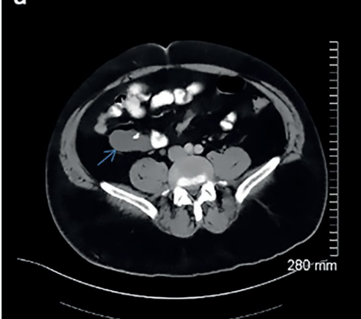 Pseudomyxoma peritonei with the characteristic omental cake encasing the transverse colon