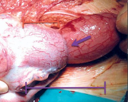 Small bowel intussusception showing components: intussusceptum (purple arrow); intussuscipiens; lead point; middle tube (red arrows)