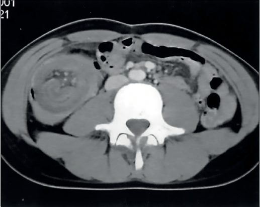 Abdominal computed tomography scan illustrating the 'target sign' of an ileocolic intussusception