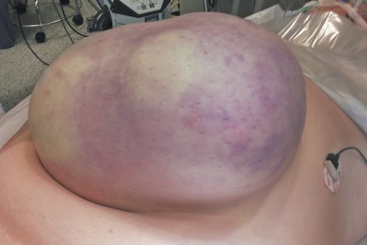 Skin discoloration over a strangulated incisional hernia