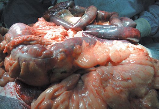 Ischaemic small and large bowel found at laparotomy in a strangulated incisional hernia