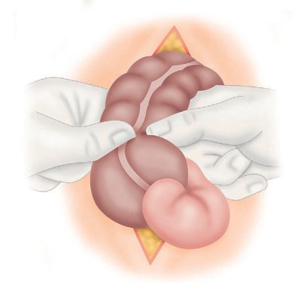 Reducing the terminal part of the intussusception (after RE Gross)