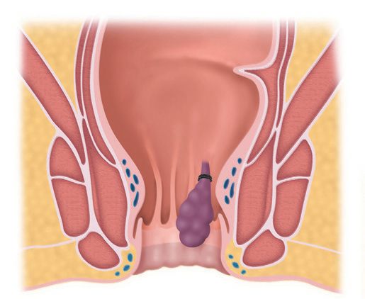 The appearance of a typical banded haemorrhoid, with the elastic band applied above the dentate line to strangulate the pedicle