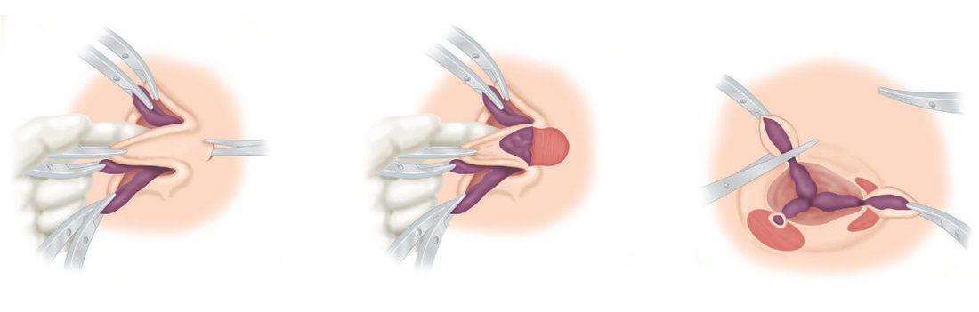 Ligation and excision of haemorrhoids, open technique: (a) artery forceps applied; (b) dissection of the left lateral pedicle; (c) transfixion of the pedicle
